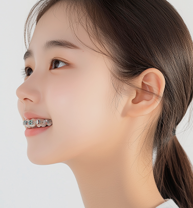 청소년기 13~18세 치열 및 교합 교정